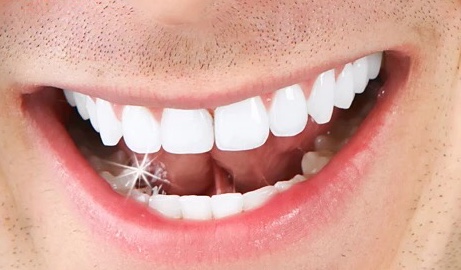 装的牙能用多久？
